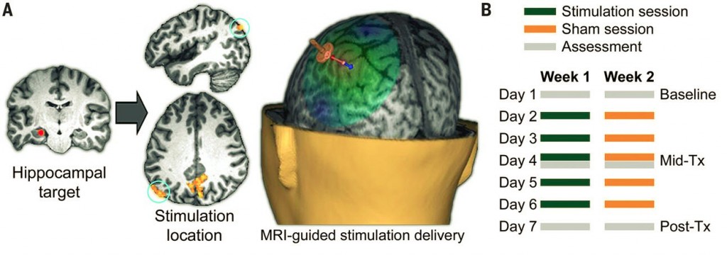 TMS Stimulation of the Parietal Cortex