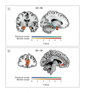Brain Morphometry Predicts Bipolar vs Unipolar