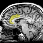 anterior cingulate cortex MRI